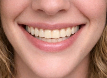 Veneer shade
