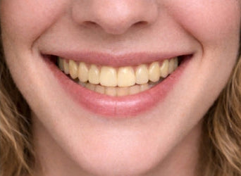 Veneer shade