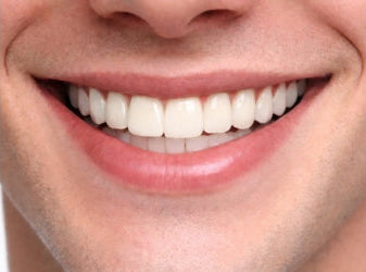 Veneer shade