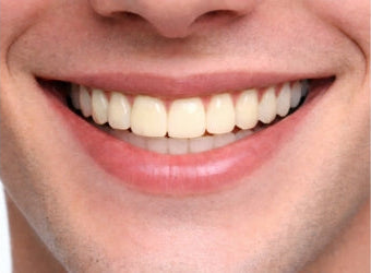 Veneer shade