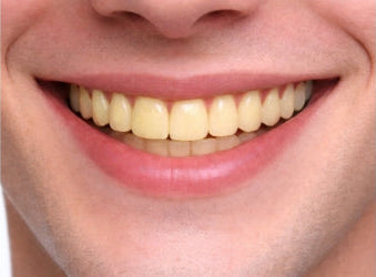 Veneer shade