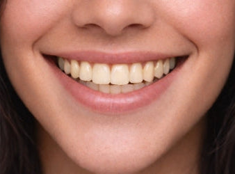 Veneer shade