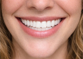 Dual Arch - Snap on Veneers