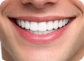 Veneer shade