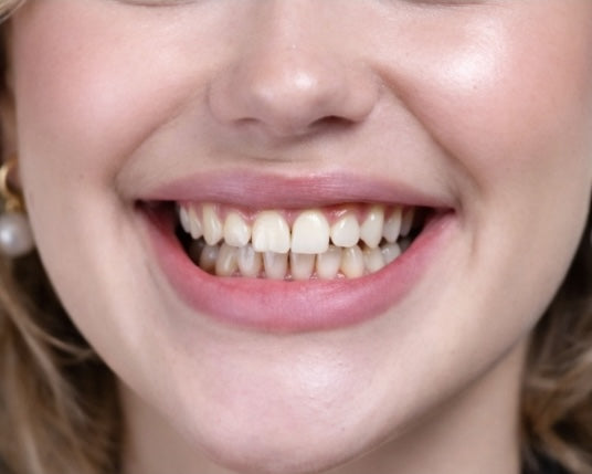 Before veneers