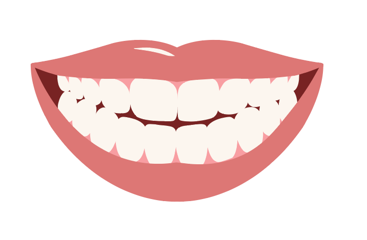 Dual Arch - Snap on Veneers